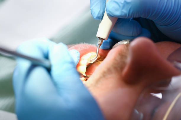 Best Emergency Root Canal Treatment in Fayette, MS